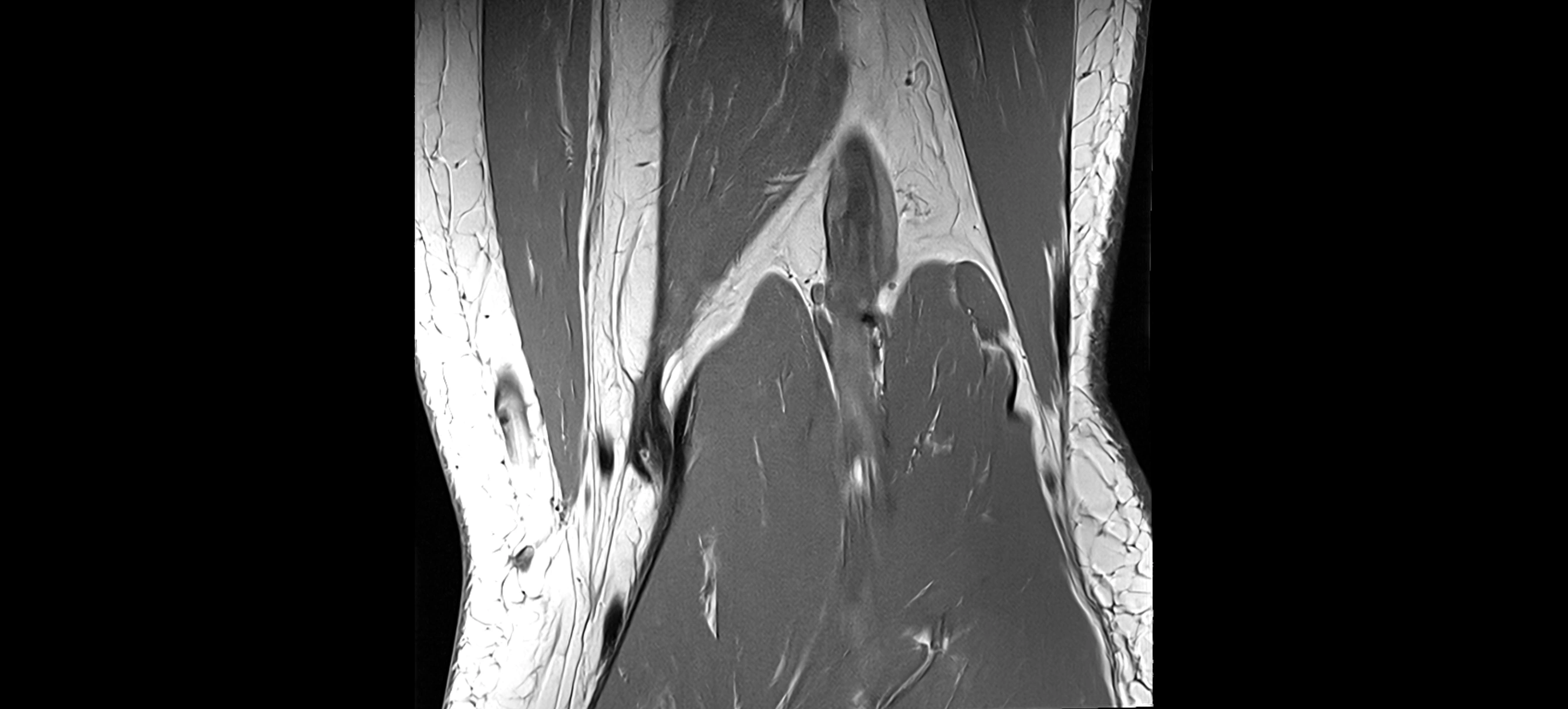 MRI coronal  ligaments cross sectional anatomy 3T  radiology  image-img-04001-00033.webp
